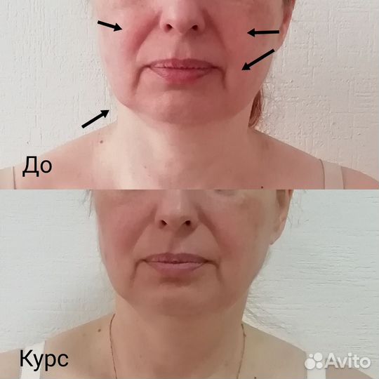 Витапластика