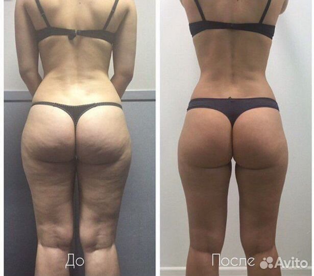 Антицеллюлитный массаж (результат гарантирован)