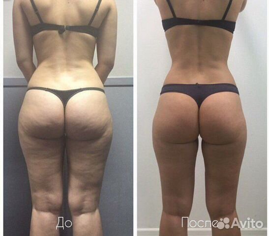 Антицеллюлитный массаж (результат гарантирован)